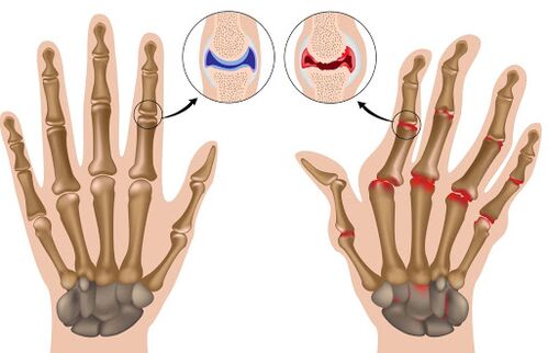 Arthritis betegség és annak megnyilvánulása