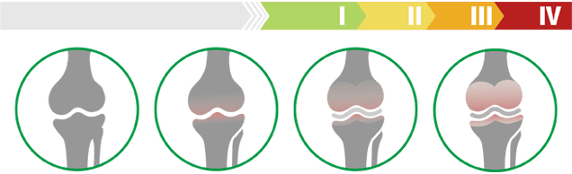 A térdízület arthrosisának klinikai szakaszai (a térdízület arthrosisának foka)