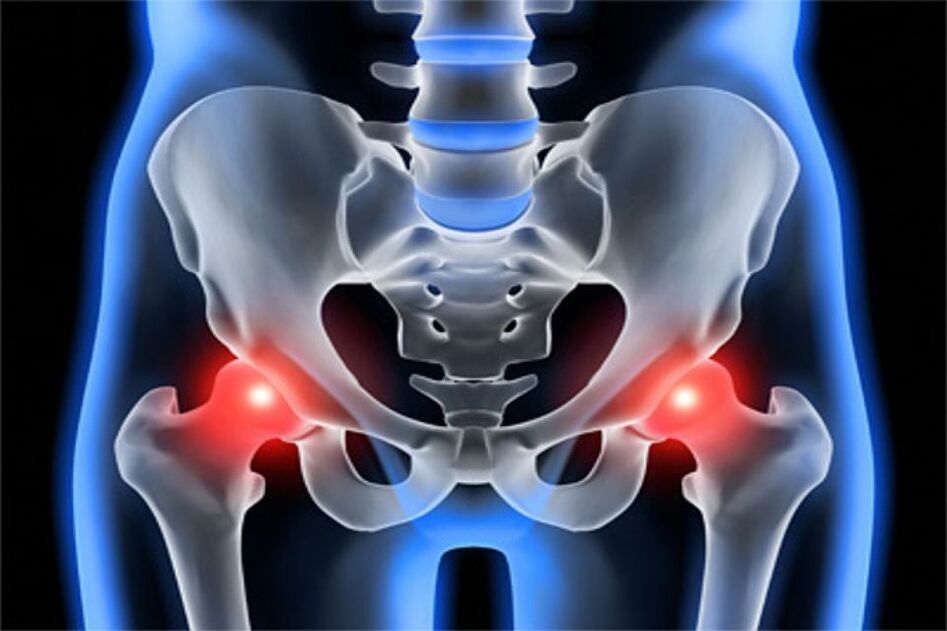 A csípőízületek deformáló artrózisa (coxarthrosis)