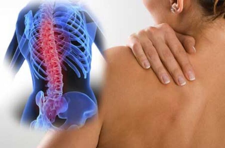 A mellkasi gerinc osteochondrosisának súlyosbodása során dorsago fájdalom lép fel