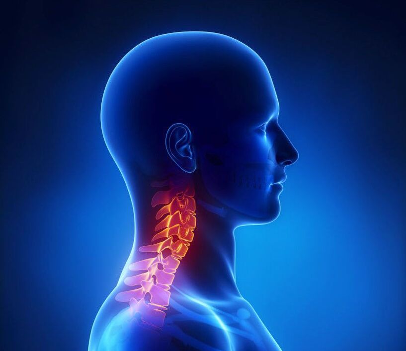 A nyaki osteochondrosis a gerinc patológiája, amelytől otthon megszabadulhat