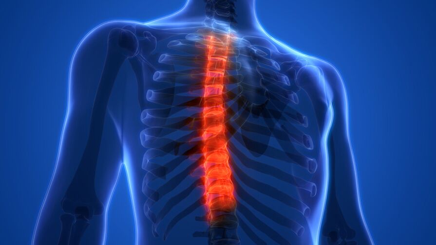 A mellkasi gerinc osteochondrosisa, amelyet a csigolyaközi lemezek pusztulása jellemez