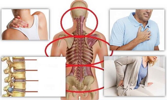 Betegséghelyek az osteokondrózishoz