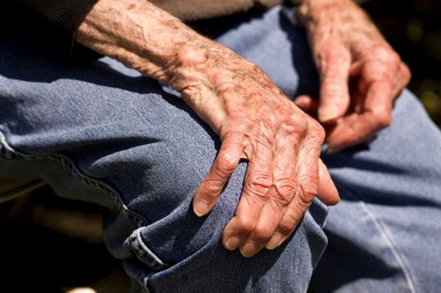 Az arthrosis egy életkorral összefüggő betegség, amely időseknél fordul elő