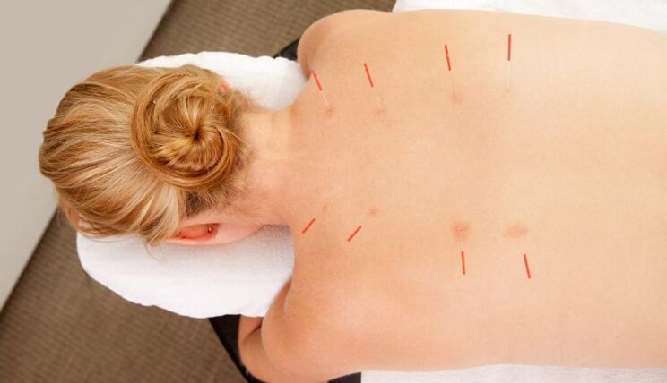 Akupunktúra a mellkasi osteochondrosis számára, amelynek számos előnye van